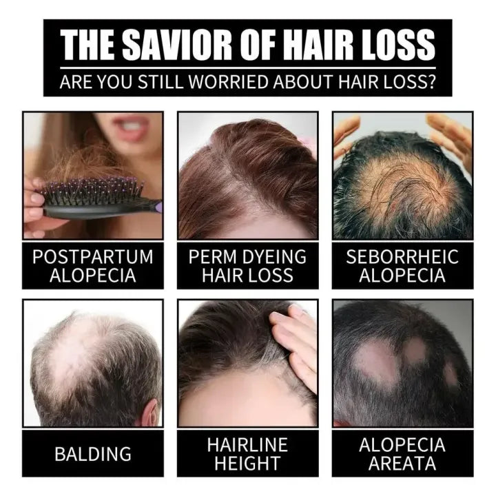 FORT Minoxidil Hair Growth Spray