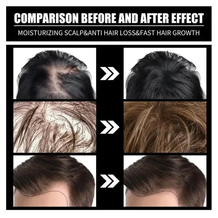 FORT Minoxidil Hair Growth Spray