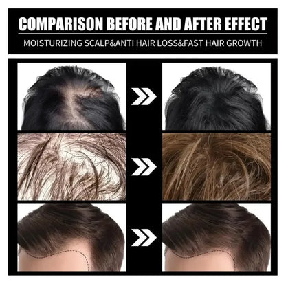 FORT Minoxidil Hair Growth Spray
